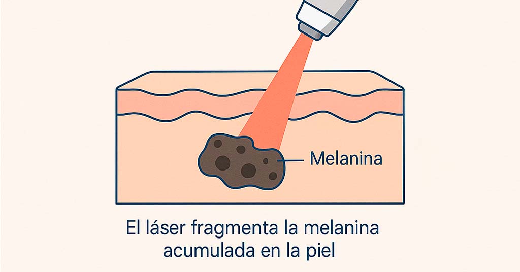 como funciona el laser